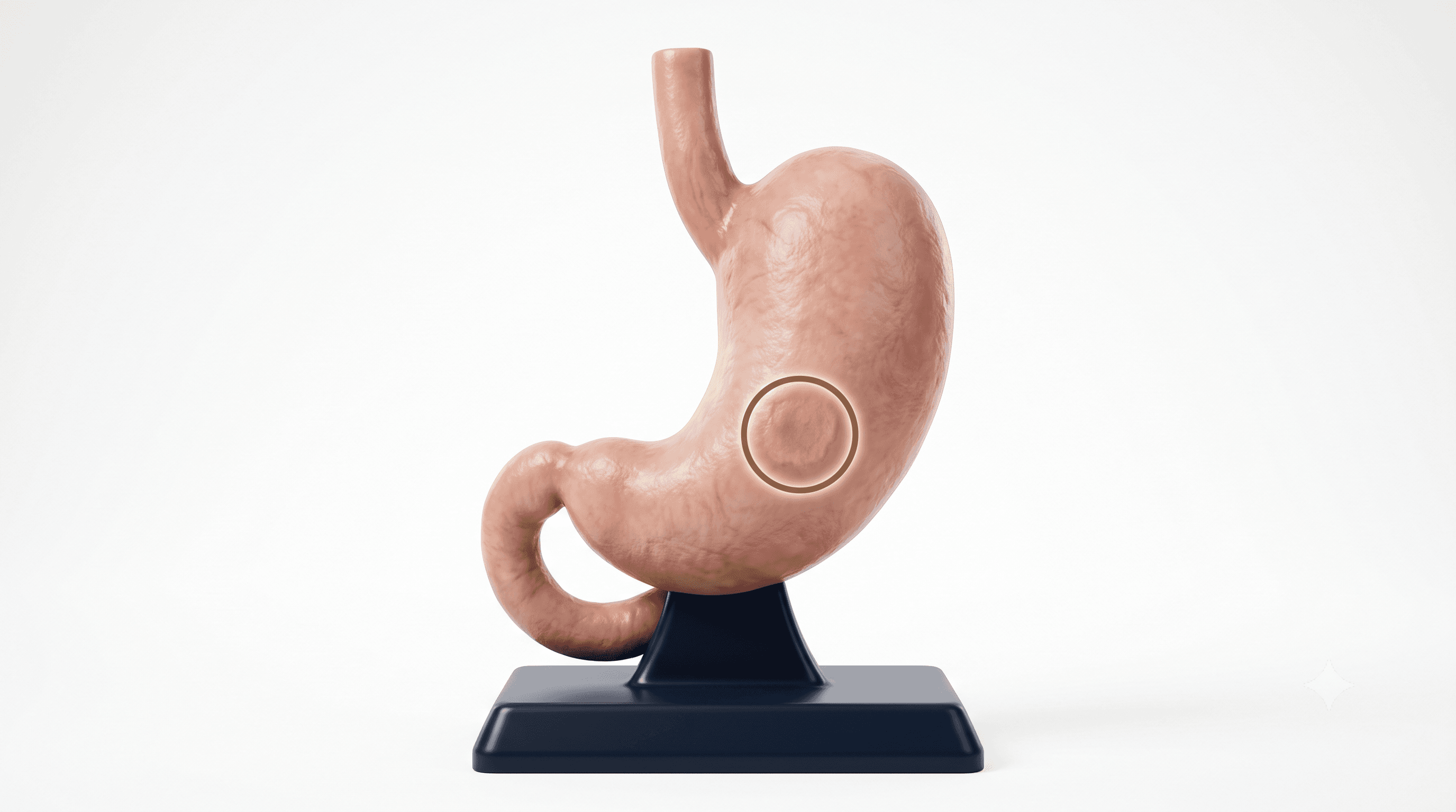 Detección Oportuna de Cáncer Gástrico